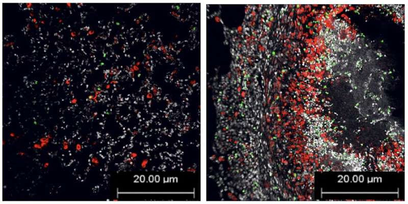 Starting antiretroviral therapy early essential to battling not one, but two killers