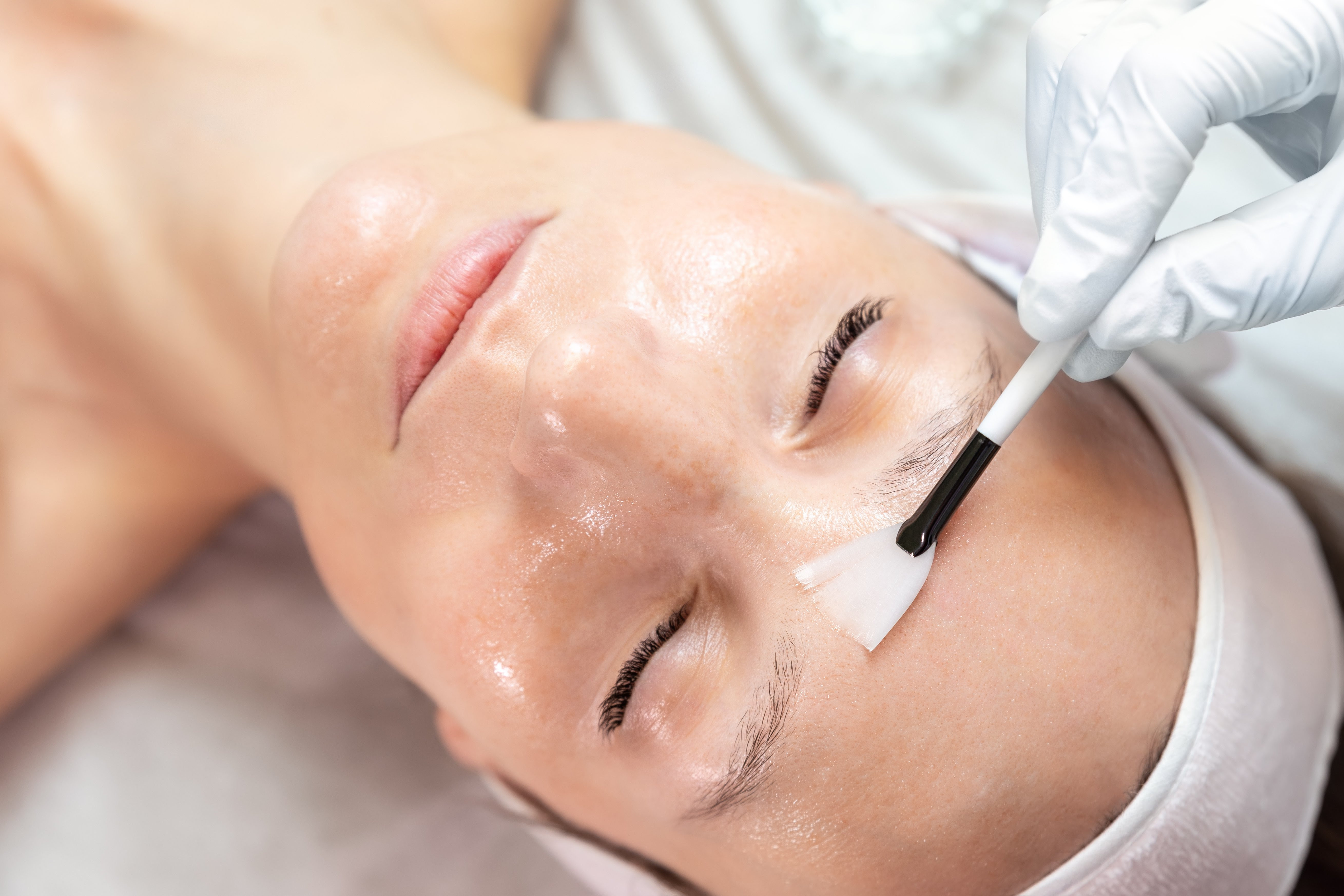 Woman receives a chemical peel treatment on her face from an esthetician