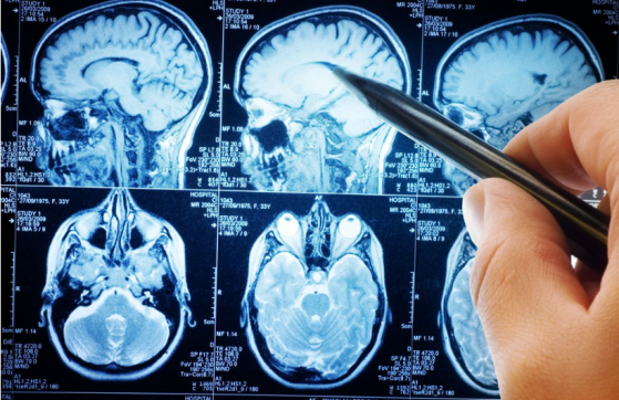 Autistic, Alzheimer’s & Multiple Sclerosis Brain Tissues Have Significant Amounts of Aluminum In Them Image-521
