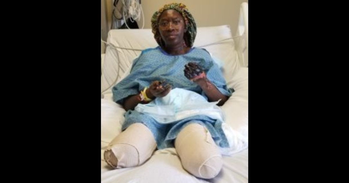 Woman Losing Hands and Legs to Amputation After Suspected Bad COVID Vaccine Reaction, Jab Was Required by Her Employer Jummai-Nache