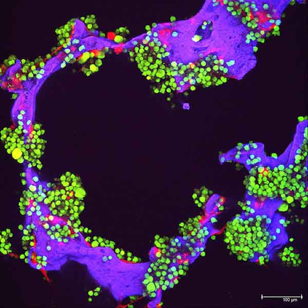 Myeloma tumor cells (green) and bone cells (red) growing on a lab-made scaffold (purple)