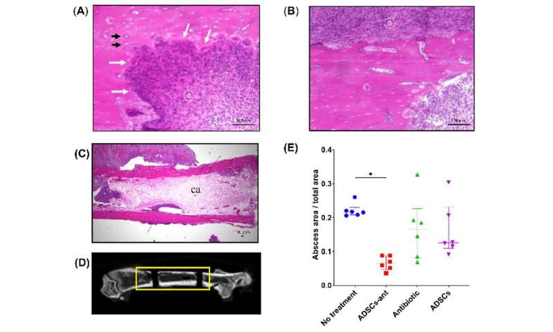 Coupling antibiotics with stem cells to fight off bone infections