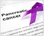 Tgen And Baylor secure federal grant to develop early detection system for pancreatic cancer