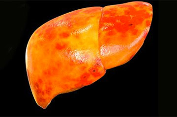 Esteatosis hepática: causas, prevención y tratamiento del hígado graso