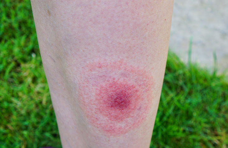 imagen de una lesion en la piel por picadura de garrapata