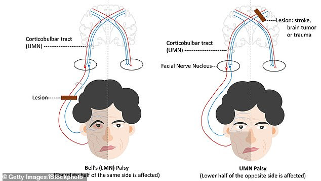 Bell's palsy is a nerve condition impacting one half of a patient's face