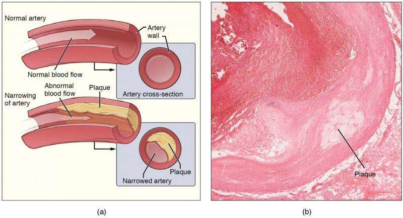 Atherosclerosis