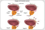 Researchers find role of iron storage gene in slowing down prostate cancer growth