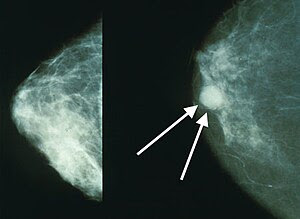 Mammo breast cancer wArrows.jpg