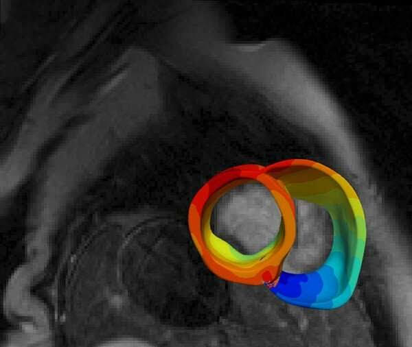 New Tool Predicts Sudden Death in Inflammatory Heart Disease