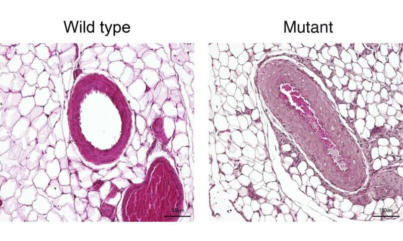 Overactive enzyme causes hereditary hypertension