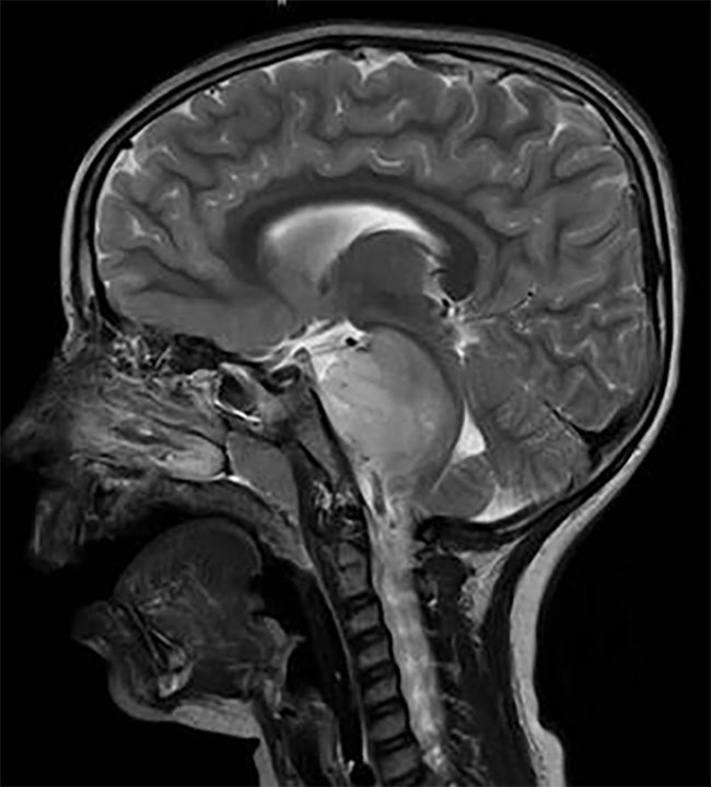 Brain scan of a child with a DIPG tumor.