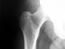 X-ray of tumor in bone