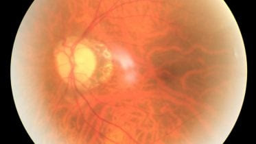 Diabetic Eetinopathy Eye Disease