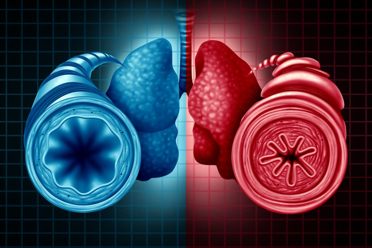 New research has uncovered a key immune mechanism that is responsible for the thickening of airway muscle associated with chronic asthma