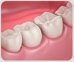 Researchers develop adhesive materials to prevent bracket stains on teeth