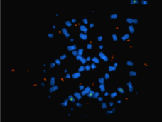 Image shows glioblastoma cells with normal x-shaped chromosomes (blue) with areas where the oncogene EGFR is found (green), but also circular pieces of DNA (red) with many additional copies of EGFR.