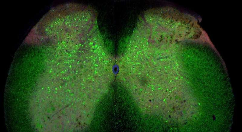 ALS development could be triggered by loss of network connections in the spinal cord