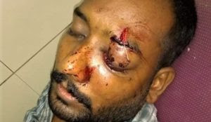 Pakistan: Christian loses sight in one eye in brutal attack by Muslim neighbors