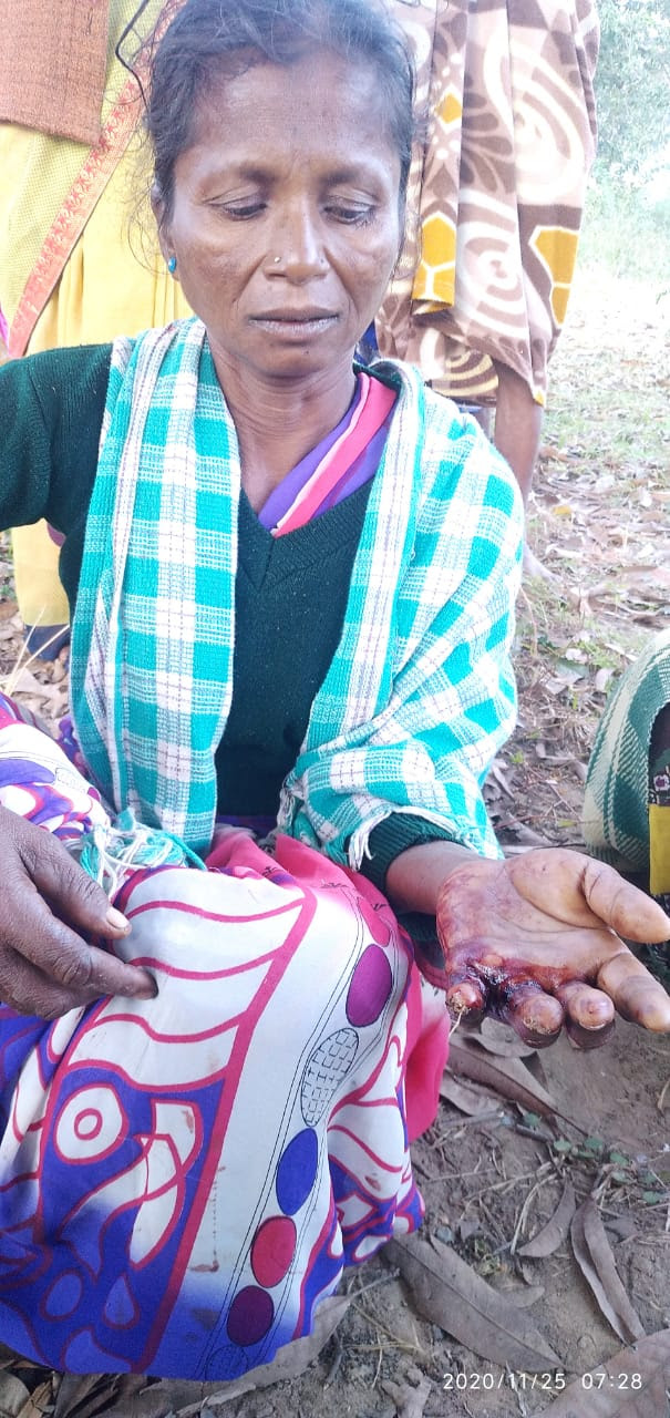  Madkam Sanni was attacked with a sickle in Chhattisgarh state, India. (Morning Star News)