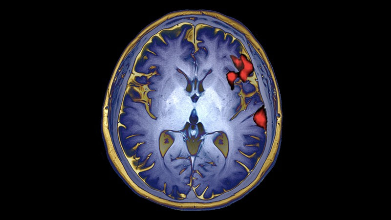 Coloured functional magnetic resonance imaging (MRIf) scan of brain activity in speech production.