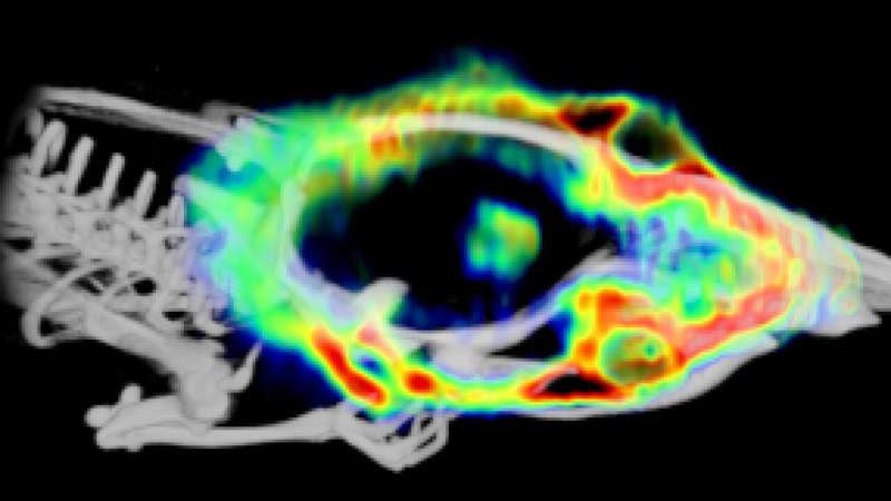 New discovery can help detect brain tumours