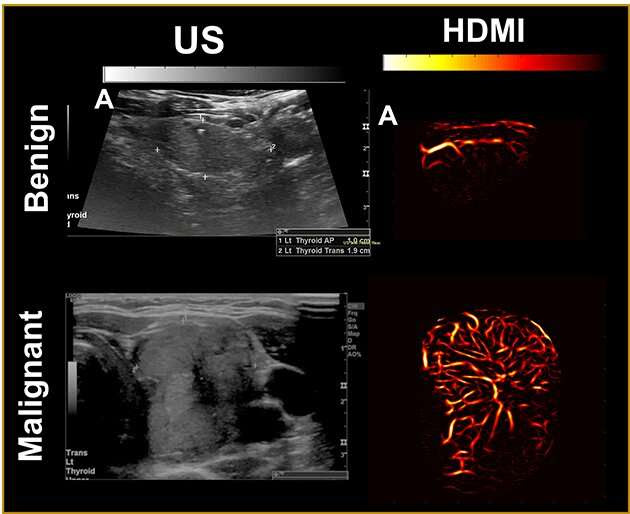 How the combination of advanced ultrasound and AI could upgrade cancer diagnostics