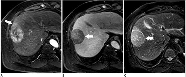 Imágenes de IRM de un tumor primario en el hígado.