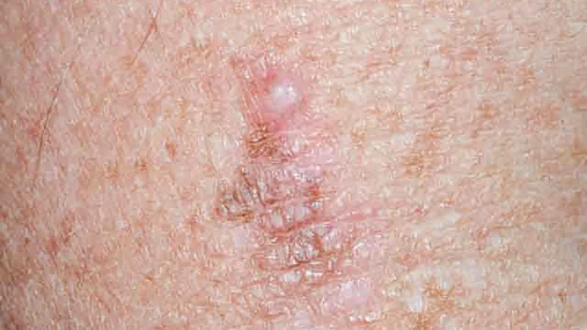A melanoma white mole without pigment.
