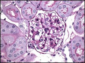 Experimental compound counters diabetic complications