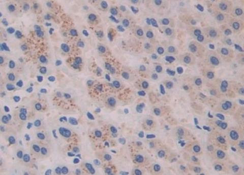 IHC-P analysis of Human Liver Cancer Tissue, with DAB staining, using Mouse Anti-Human CTXI Antibody (20 µg/ml) and HRP-conjugated Goat Anti-Mouse antibody (abx400001, 2 µg/ml).