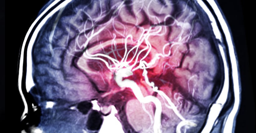 An MRI of the brain's blood vessels, which appear bright red.