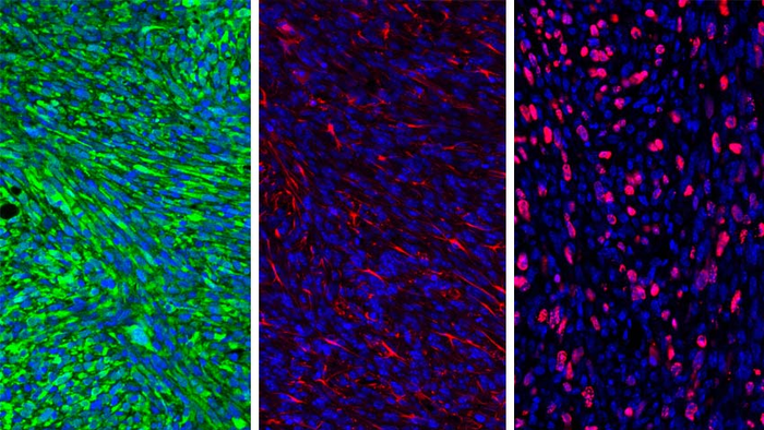 glioma cells