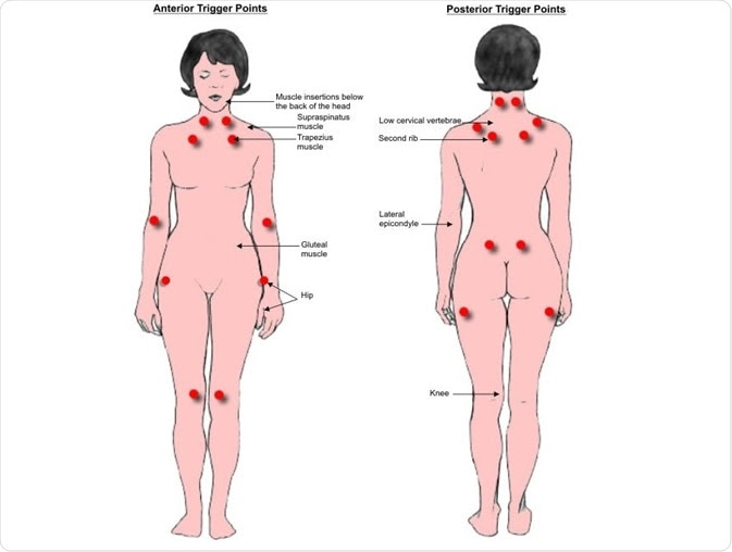 Fibromyalgia trigger points.