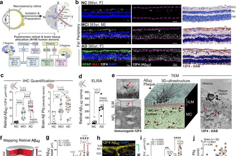 New insights: Eye damage in Alzheimer's disease patients