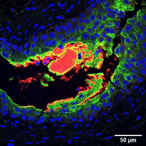 New study explains link between diabetes and UTIs