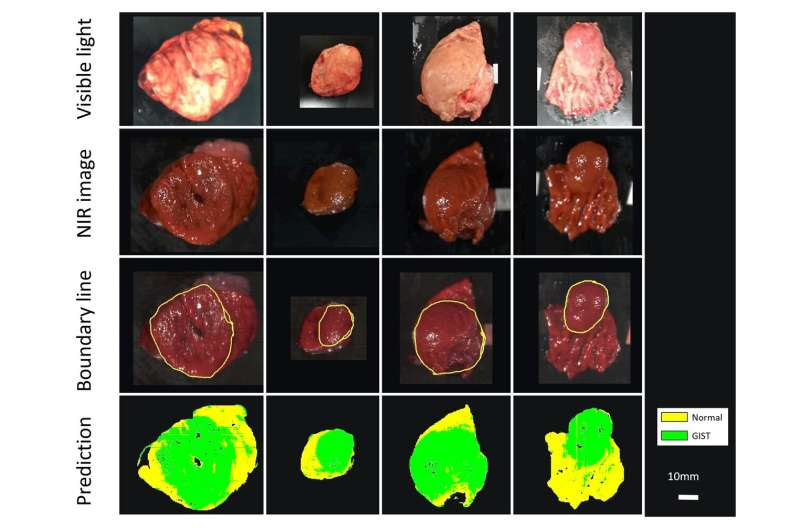 Near-infrared imaging and machine learning can identify hidden tumors