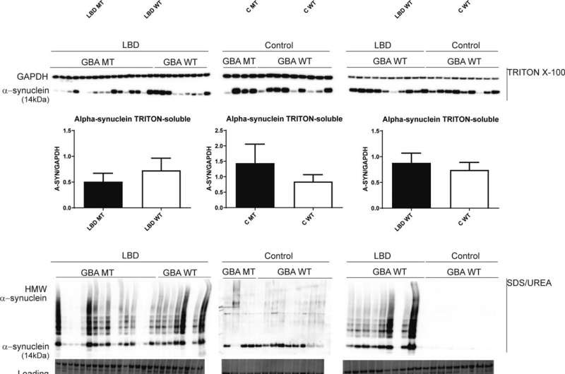 Role of fats and proteins in Lewy Body dementia