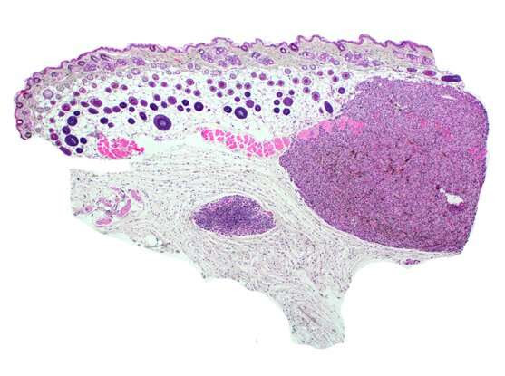 Researchers use CRISPR to build melanoma models from scratch using human cells