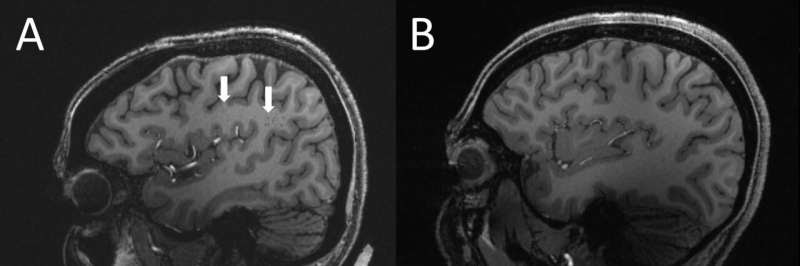 Ultra-high-res MRI reveals migraine brain changes