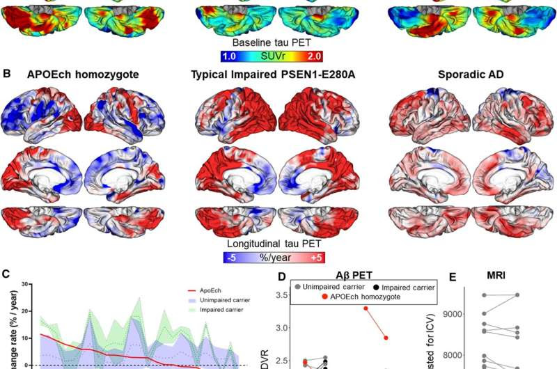 An Alzheimer's-defying brain offer clues to treatment and prevention of dementia