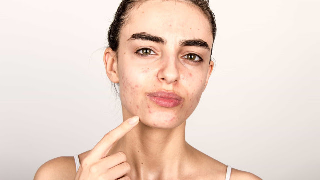 A acne surge apenas em peles oleosas?