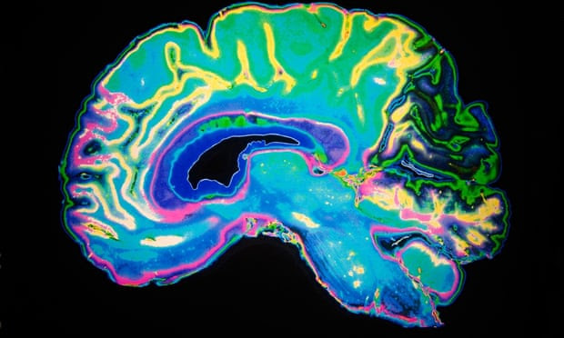 An MRI scan of a human brain