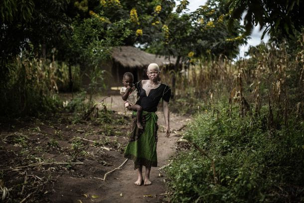 -- AFP PICTURES OF THE YEAR 2015 -- Mainasi Issa, a 23-year-old Malawian albino woman, carries her tow-year-old daughter Djiamila Jafali as she poses outside her hut in the traditional authority area of Nkole, Machinga district, on April 17, 2015. Six albinos have been killed in the poor southern African nation since December, according to the Association of Persons with Albinism in Malawi. AFP PHOTO / GIANLUIGI GUERCIA