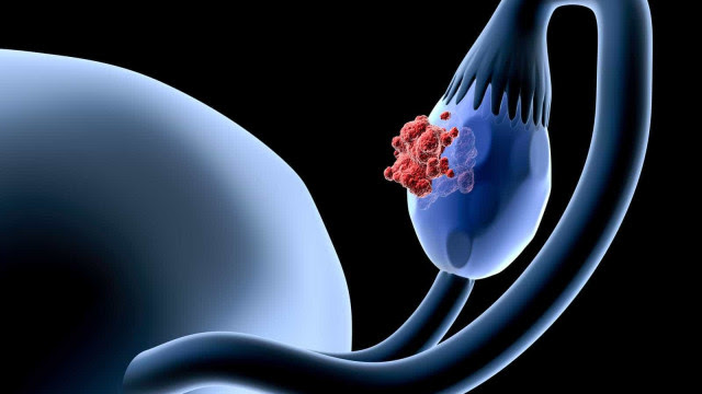 Saiba quais são os sintomas e tratamentos do câncer de ovário