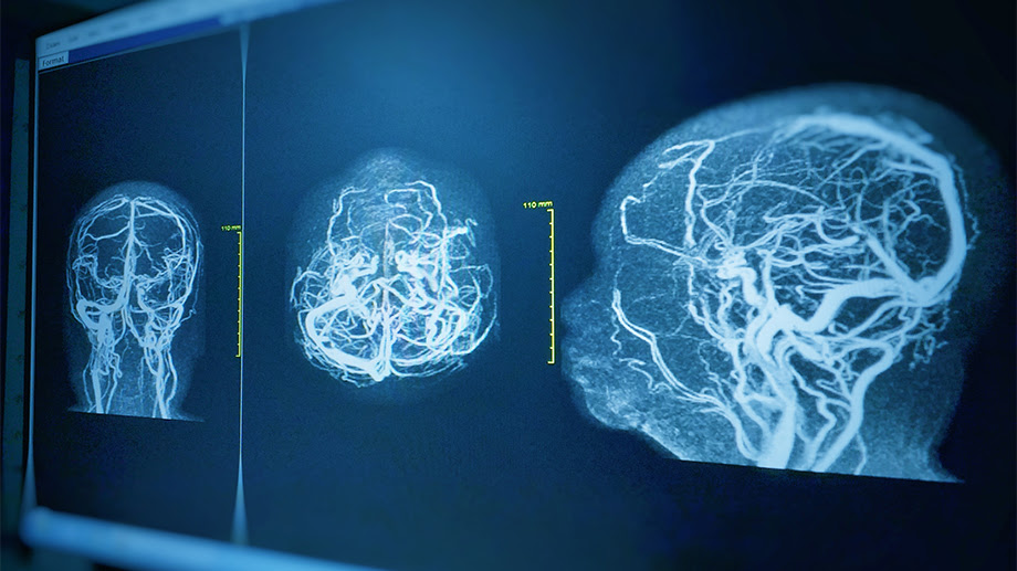 Three MRI images showing the brain blood vessels displayed on a computer monitor.