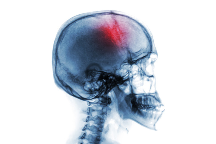imagen de una lesion en la cabeza vista como radiografia 
