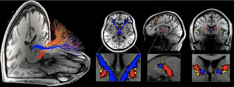 Human cocaine and heroin addiction is found tied to impairments in specific brain circuit initially implicated in animals