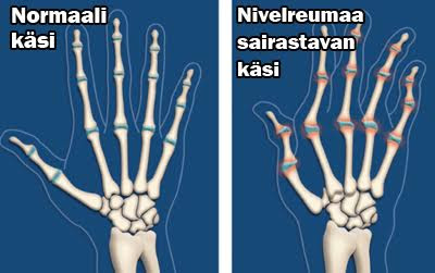 Tuki- Ja Liikuntaelinsairaudet – Juhon Terveystieto