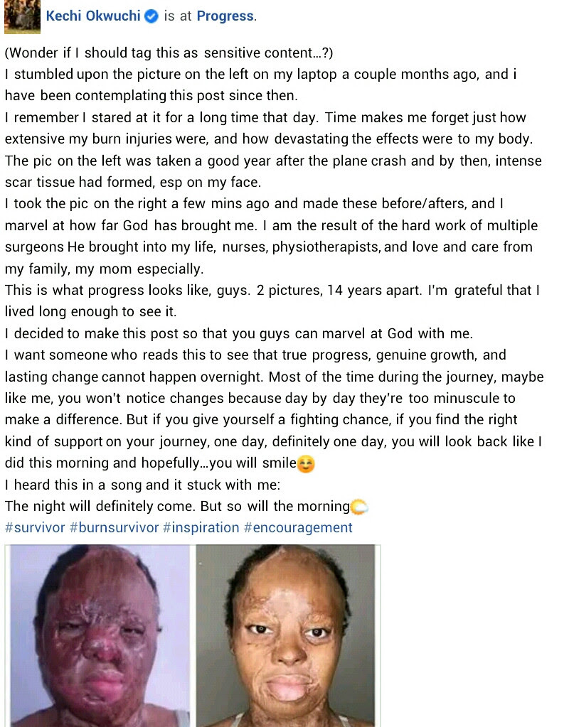  I?m grateful I lived long enough to see it - Plane crash survivor, Kechi Okwuchi bares her facial scars as she shares recovery journey 